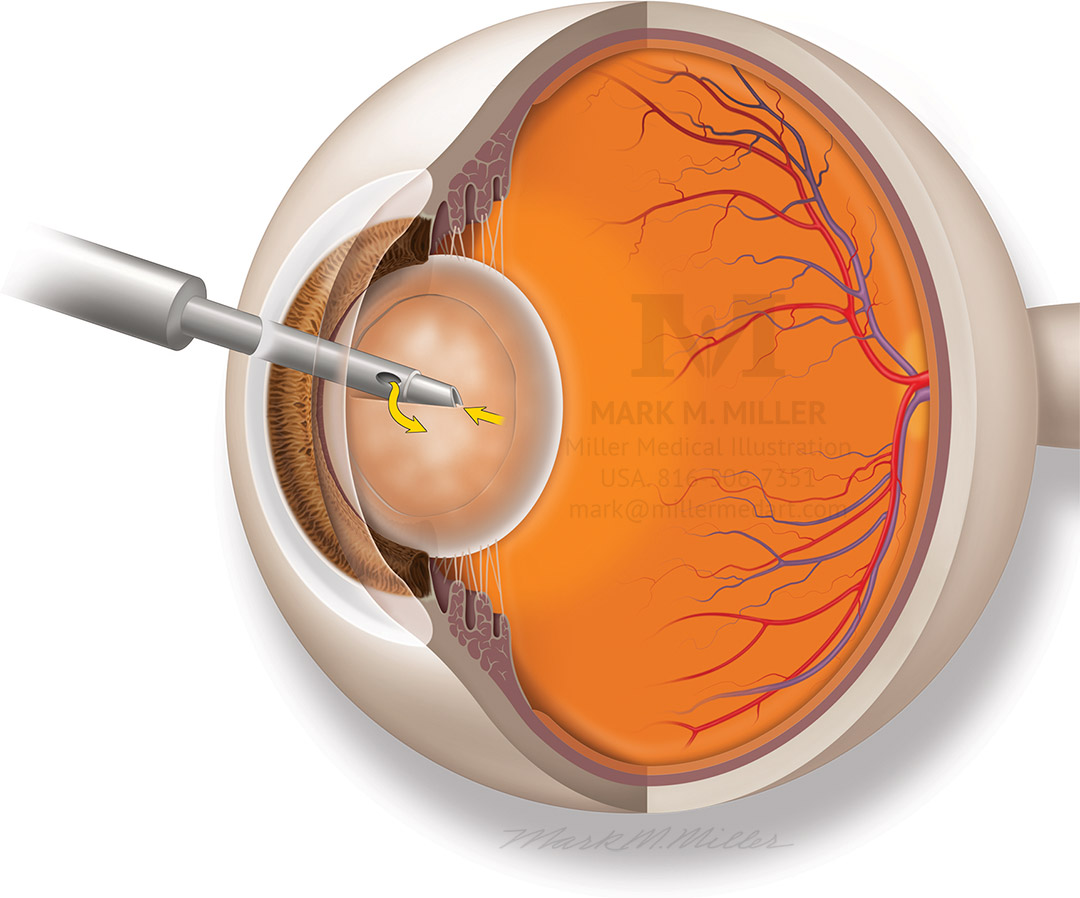 A medical illustration showing phacoemulsification of the lens for cataract